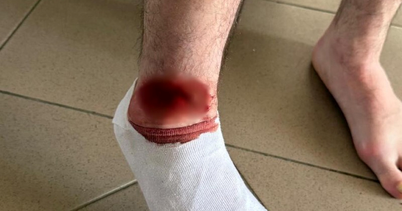 UZNEMIRUJUĆE Ovako je izgledala noga napadača Dugopolja nakon duela u drugoj ligi