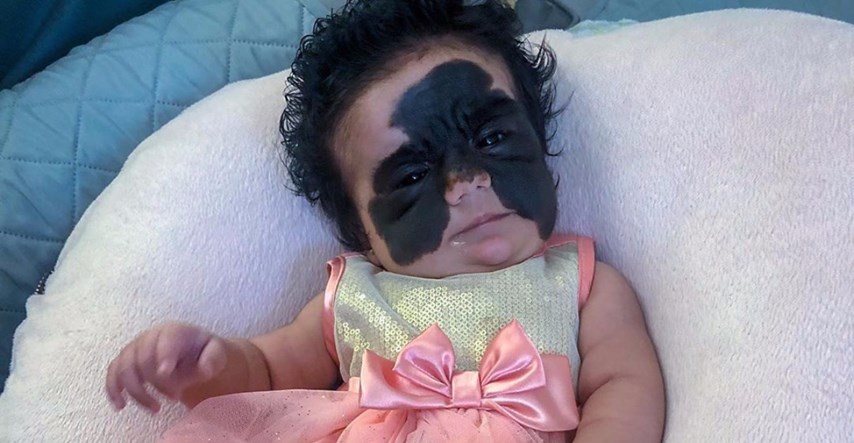 Bebu nazivaju čudovištem zbog velikog crnog madeža na licu