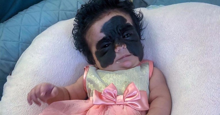 Bebu nazivaju čudovištem zbog velikog crnog madeža na licu