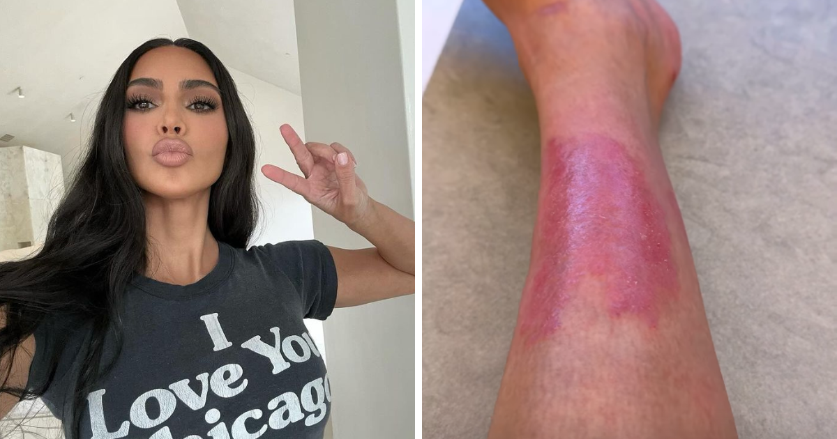 Kim Kardashian pokazala kako izgledaju posljedice psorijaze: "Neću lagati, boli"