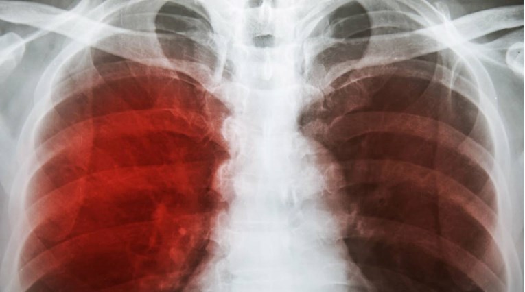 Žena u SAD-u dobila tuberkulozu, odbila se liječiti. Sada joj prijeti zatvor 