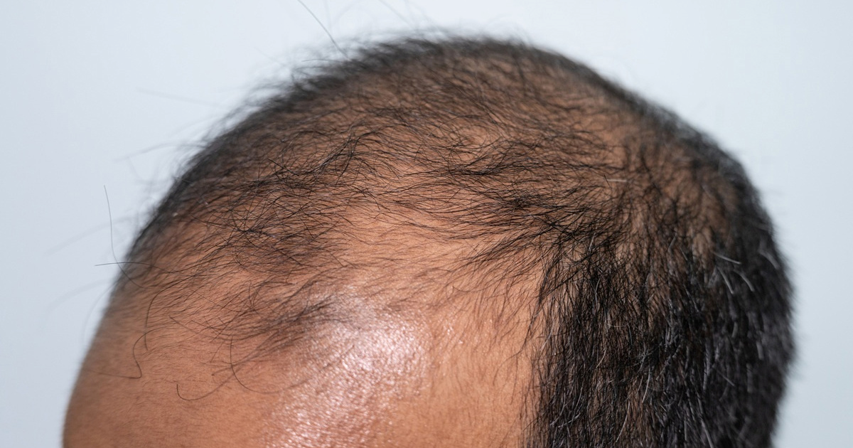 Znanstvenici otkrili novi gel u borbi protiv ćelavljenja