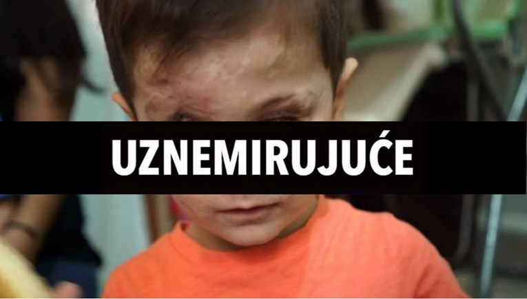 UZNEMIRUJUĆE Ovako izgleda lice djeteta godinu nakon zračnog napada u Siriji