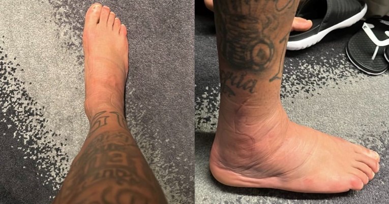 FOTO Neymar pokazao kako izgleda ozljeda koju je zaradio na utakmici sa Srbijom