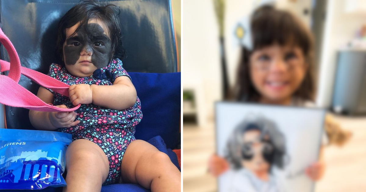 Djevojčicu su zvali čudovištem zbog madeža na licu, pogledajte kako danas izgleda