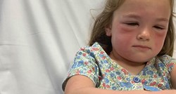 Mama upozorila: Moja kći je imala zastrašujuću alergijsku reakciju na gusjenicu!