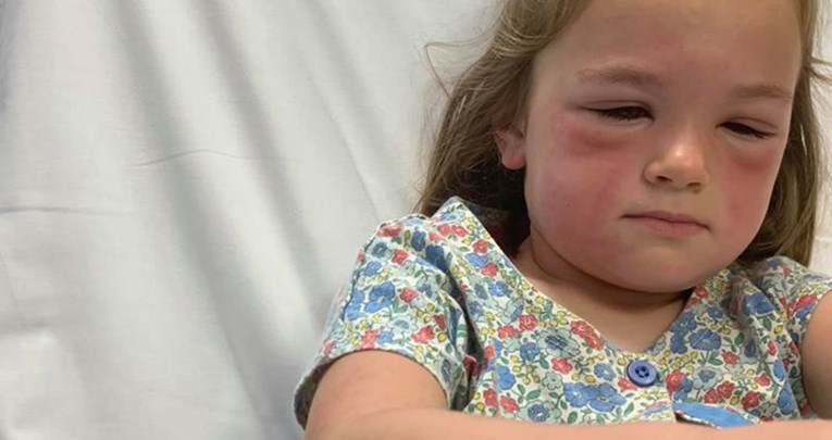 Mama upozorila: Moja kći je imala zastrašujuću alergijsku reakciju na gusjenicu!