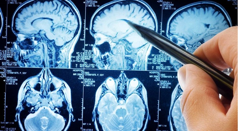 Svaka nova memorija oštećuje moždane stanice, tvrde znanstvenici