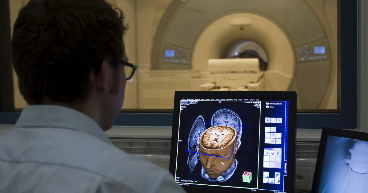 Menopauza povezana s promjenama u mozgu sličnim Alzheimeru