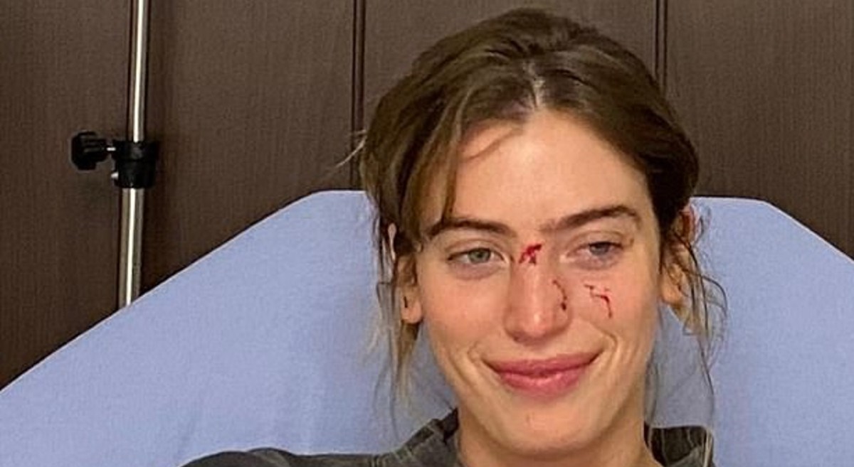 Na crveni tepih došla ozlijeđenog lica, otkriveno što joj se dogodilo pola sata prije