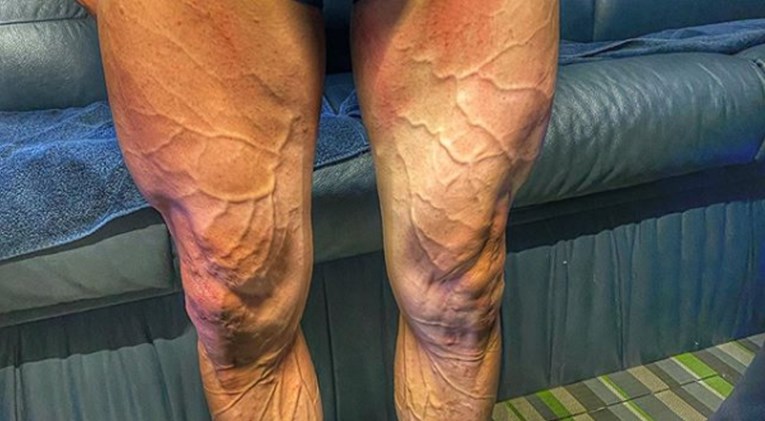 Pogledajte kako izgledaju noge španjolskog biciklista nakon utrke od četiri sata