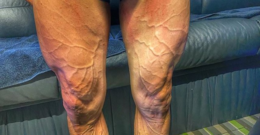 Pogledajte kako izgledaju noge španjolskog biciklista nakon utrke od četiri sata