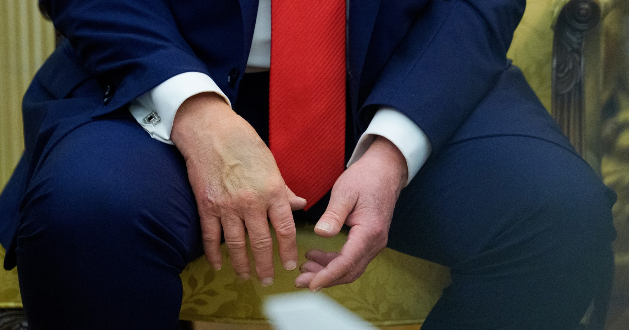 Trump (79) ide na liječnički pregled, internetom se i dalje šire fotografije modrica