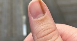 Žena je 10 godina imala smeđu prugu ispod nokta pa doznala da je to rak kože