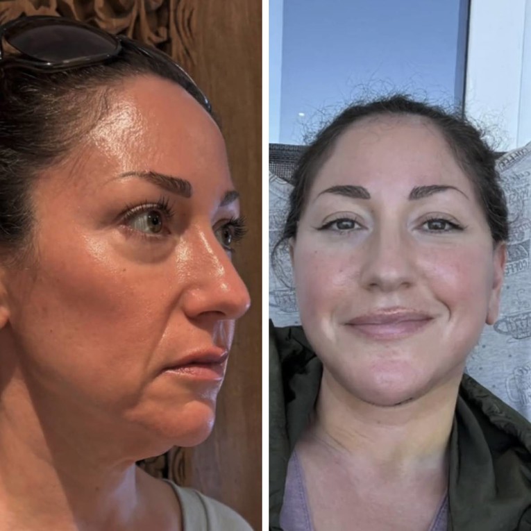 Amerikanka (49) otišla na facelifting u Meksiko, ljudi ne vjeruju da je ista osoba