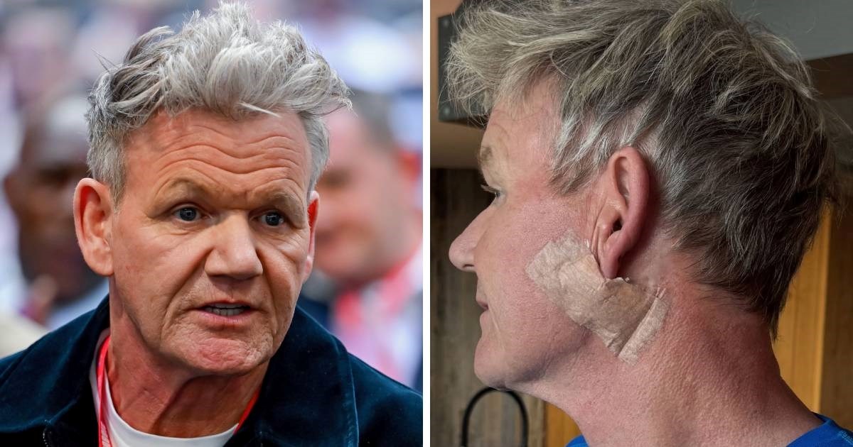 Gordon Ramsay objavio fotke nakon operacije: "Uklonili su mi karcinom"