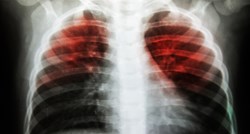 Otporna tuberkuloza u velikom porastu u nekim dijelovima svijeta. Otkriveno je zašto