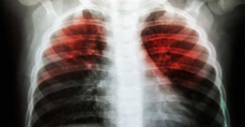 Otporna tuberkuloza u velikom porastu u nekim dijelovima svijeta. Otkriveno je zašto