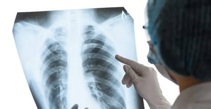 Pet mitova o raku pluća u koje moramo prestati vjerovati