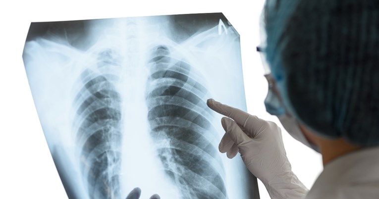 Pet mitova o raku pluća u koje moramo prestati vjerovati