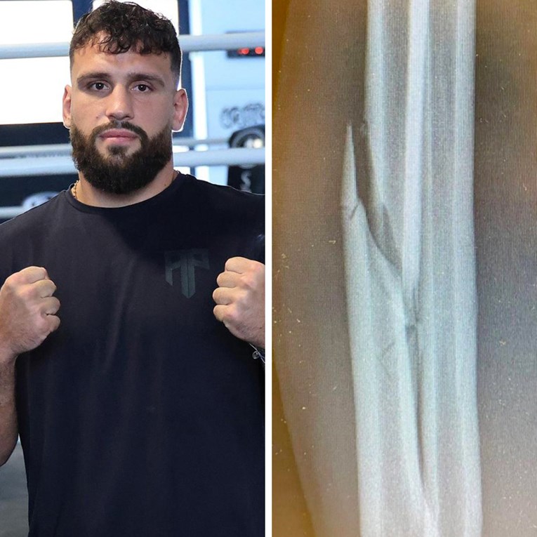 Plazibat se vratio i pobijedio. Ovako mu je izgledala ruka prije 911 dana