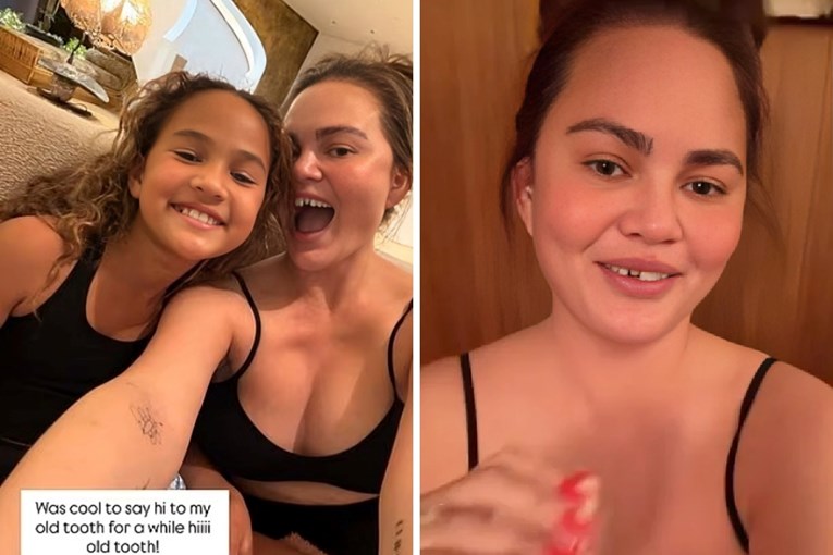 Chrissy Teigen ostala bez prednjeg zuba zbog božićnog slatkiša