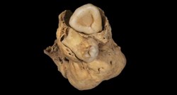 FOTO U tijelu drevne Egipćanke pronađen čudan tumor sa zubima
