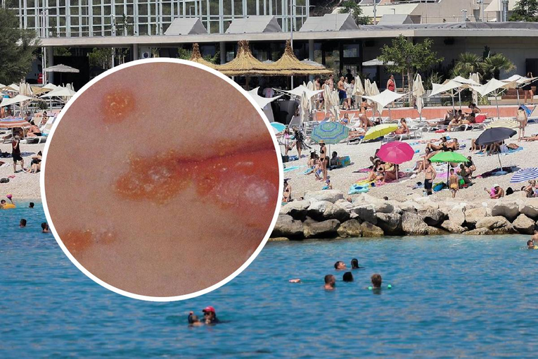 Sve više djece u Splitu ima impetigo. Evo kako ga prepoznati