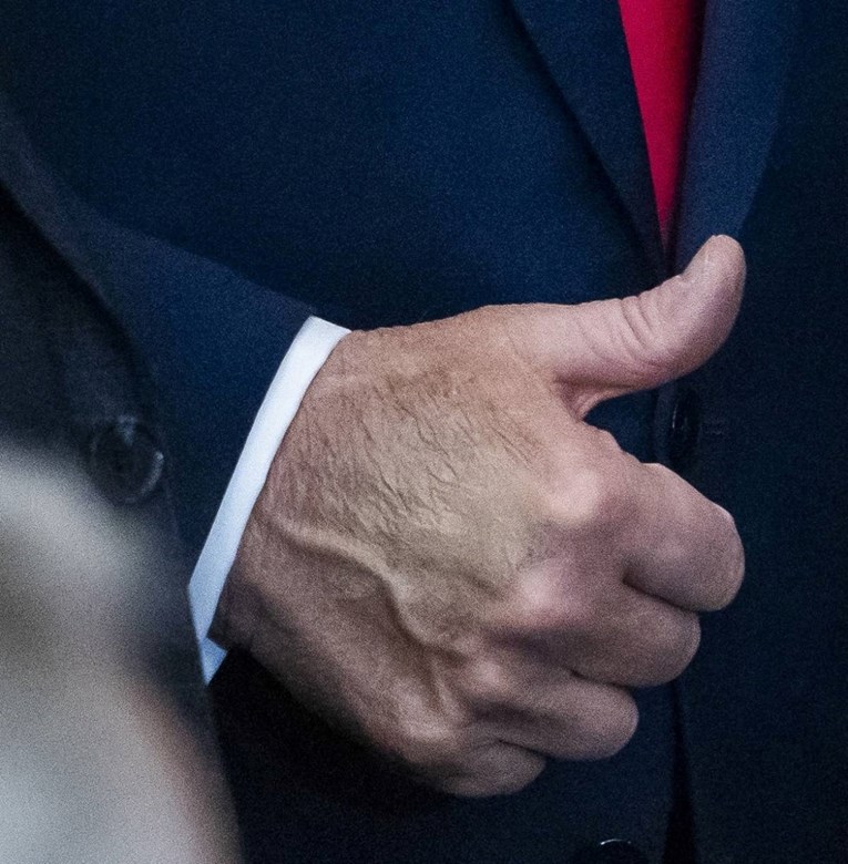 Trumpu dijagnosticirana kronična venska insuficijencija. Što je to?