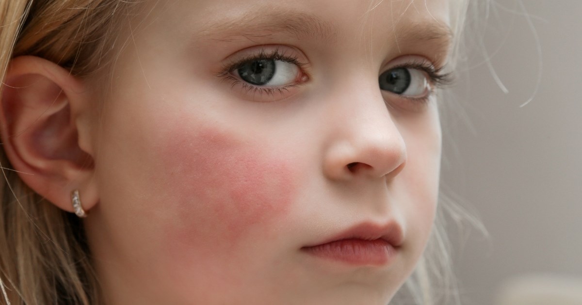 Peta bolest kruži vrtićima i školama: Koji su simptomi i tko je u riziku?