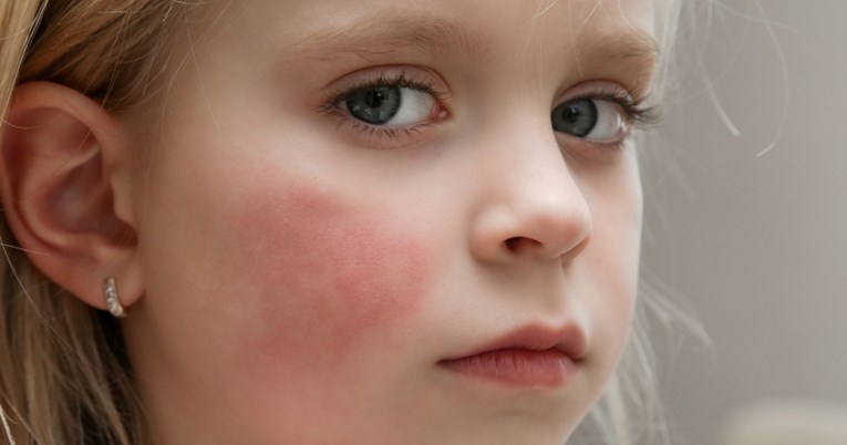 Peta bolest kruži vrtićima i školama: Koji su simptomi i tko je u riziku?