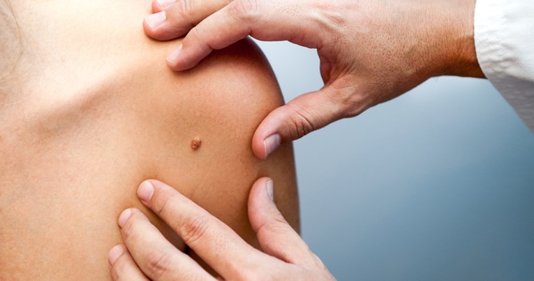 Pet najranijih znakova raka kože na koje treba obratiti pozornost