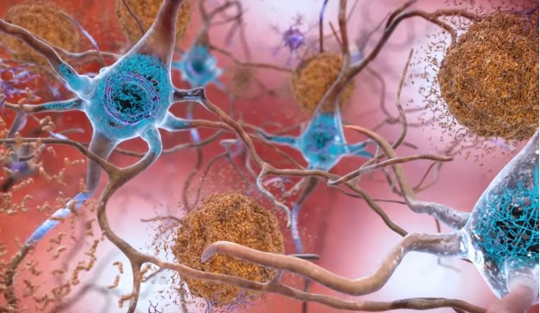 Studija: Ako genetski modificiramo stanice mozga možemo spriječiti pojavu Alzheimera
