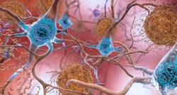 Studija: Genetski modificirane stanice mozga mogle bi spriječiti pojavu Alzheimera