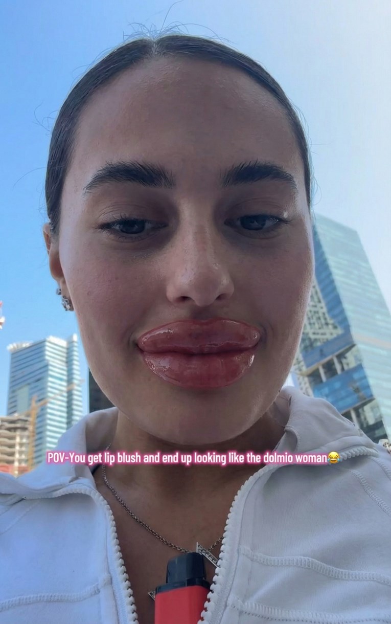Prvi put isprobala "lip blush" pa pokazala rezultat, ljudi umiru od smijeha