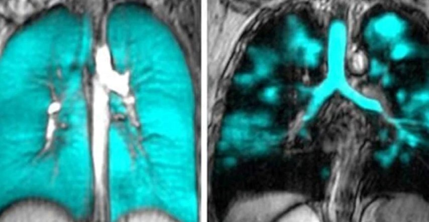 FOTO Nova tehnika snimanja jasno pokazala izvor dugog covida u plućima