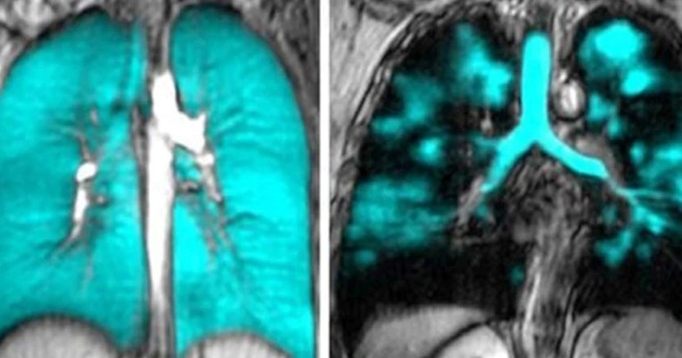 FOTO Nova tehnika snimanja jasno pokazala izvor dugog covida u plućima