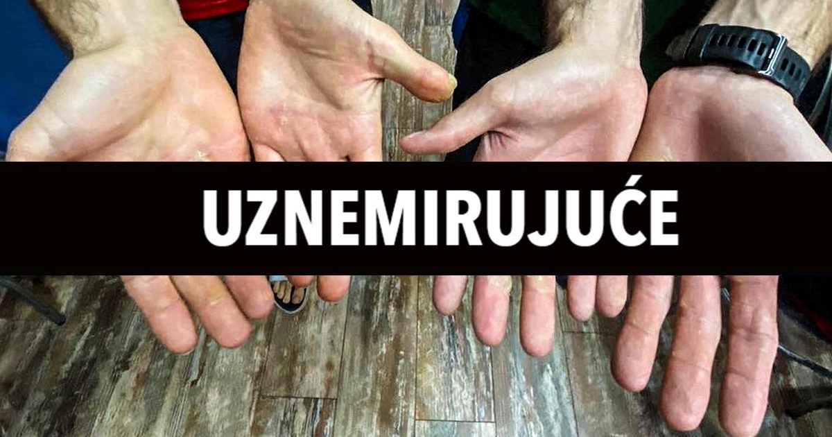 Pogledajte kako izgledaju dlanovi braće Sinković. Fotografije su uznemirujuće