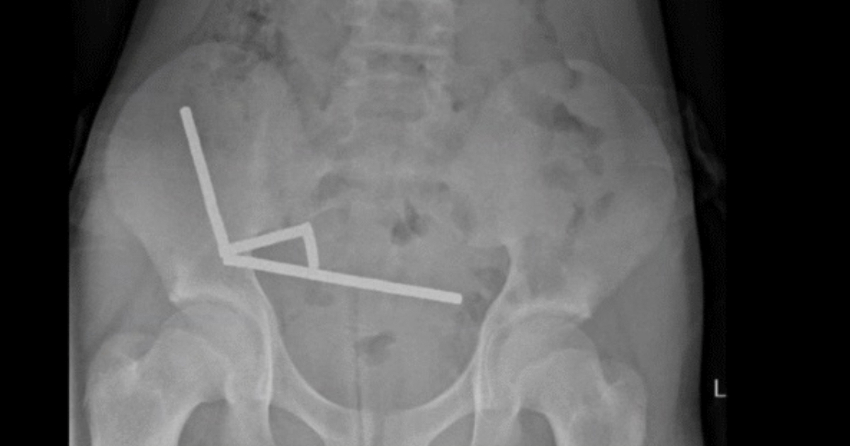 Tinejdžer s Novog Zelanda progutao 200 magneta, kirurzi mu uklonili dio crijeva