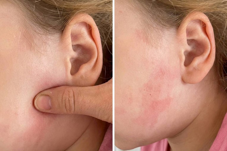 Roditelji često misle da je riječ o virozi, a ovaj osip može značiti životnu opasnost