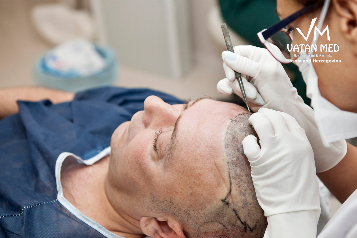 Poznati nedostatak kose rješavaju transplantacijom, u Sarajevu to možete i vi