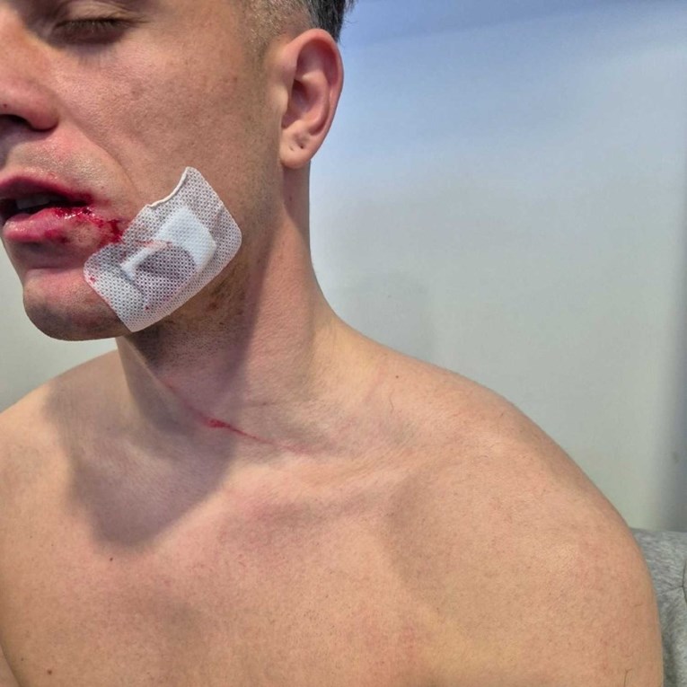 FOTO Ovako izgleda Lučić nakon prekršaja za koji je Galešić dobio crveni karton