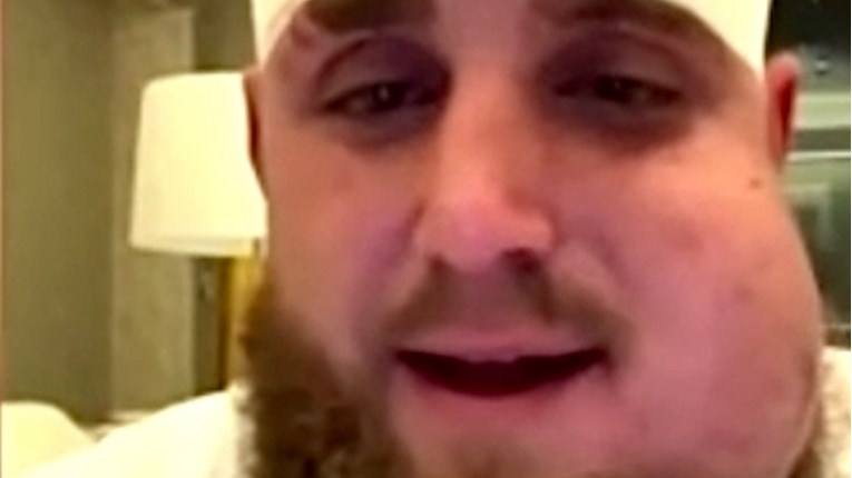 Ovako izgleda Paul nakon što mu je Joshua na dva mjesta slomio čeljust