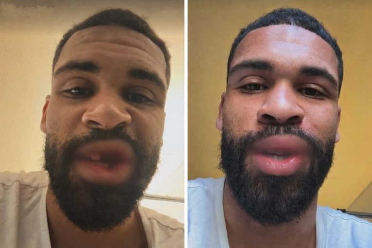 Golman izbio zube igraču Milana. Dan nakon utakmice objavio je kako mu izgleda lice