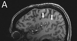 Kod ljudi s migrenama uočene misteriozne promjene u mozgu