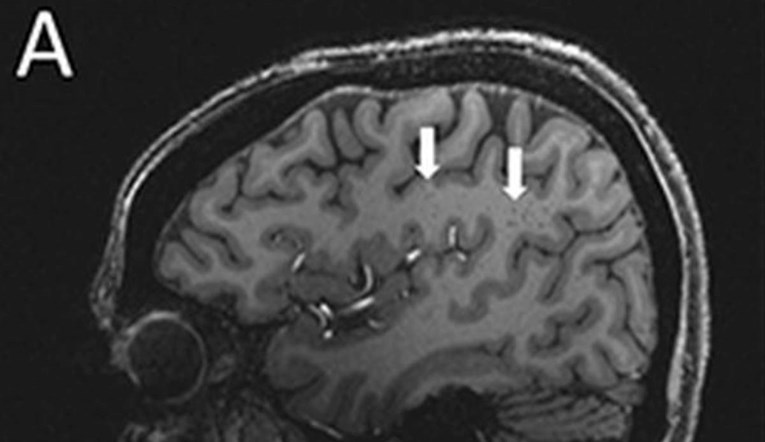 Kod ljudi koji pate od migrena snimljene misteriozne promjene u mozgu