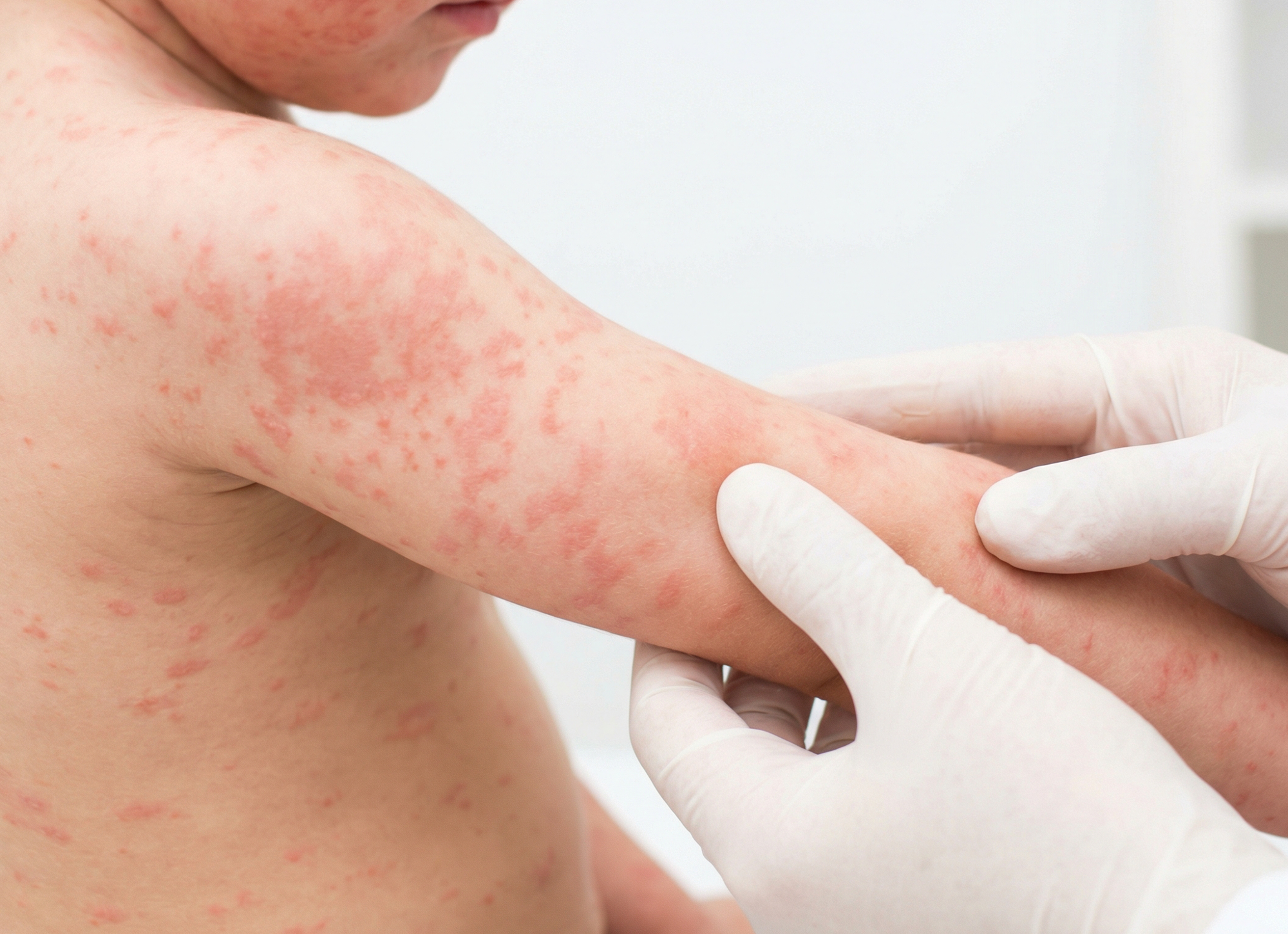 Epidemija ospica u Londonu: Zaraženo više od 60 djece