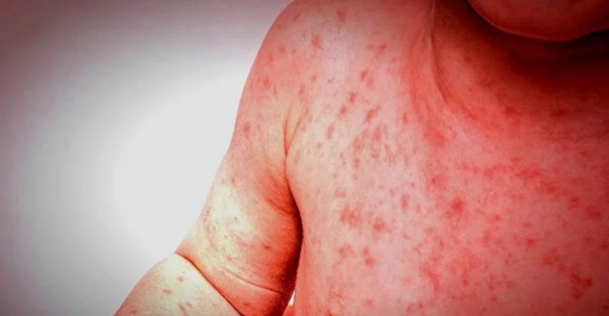 WHO upozorava: U tijeku najgora epidemija ospica u posljednjih 13 godina