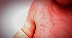 WHO upozorava: U tijeku najgora epidemija ospica u posljednjih 13 godina