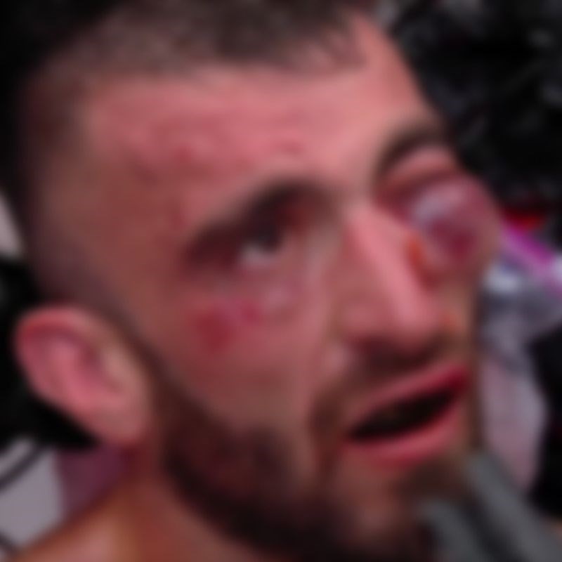 VIDEO UZNEMIRUJUĆE Borac doživio jednu od najružnijih ozljeda u povijesti UFC-a